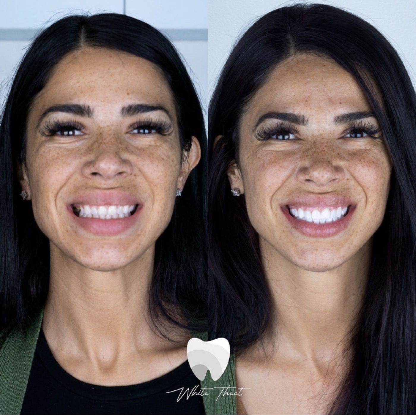 Porcelain veneer smile design result in Colombia