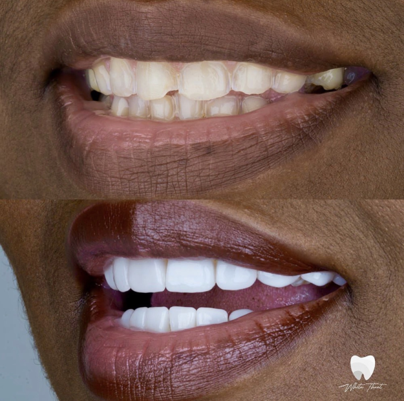 Aesthetic dental treatment result