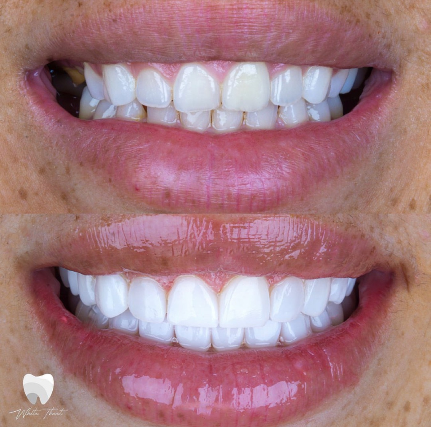Smile transformation before and after