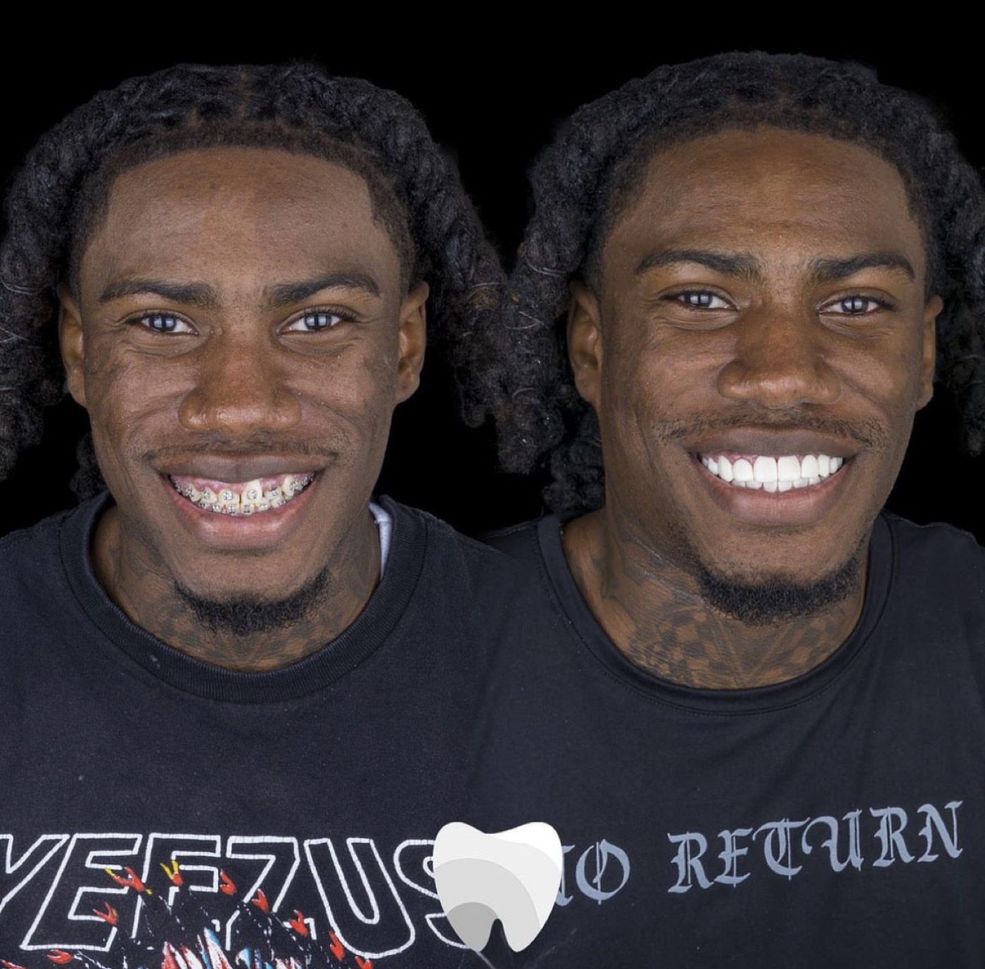 White Teeth Colombia smile makeover result