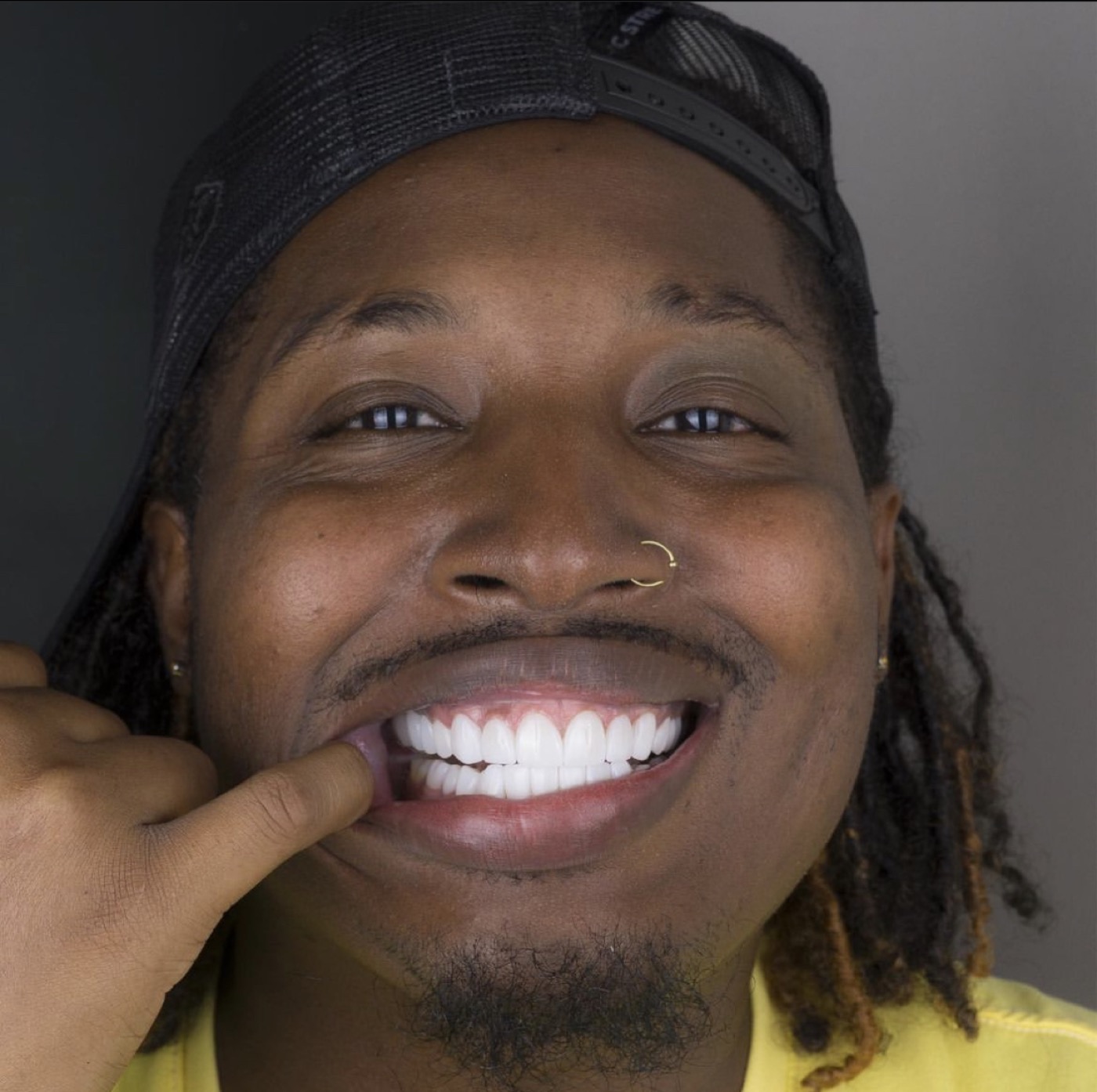 Luxury smile makeover patient result