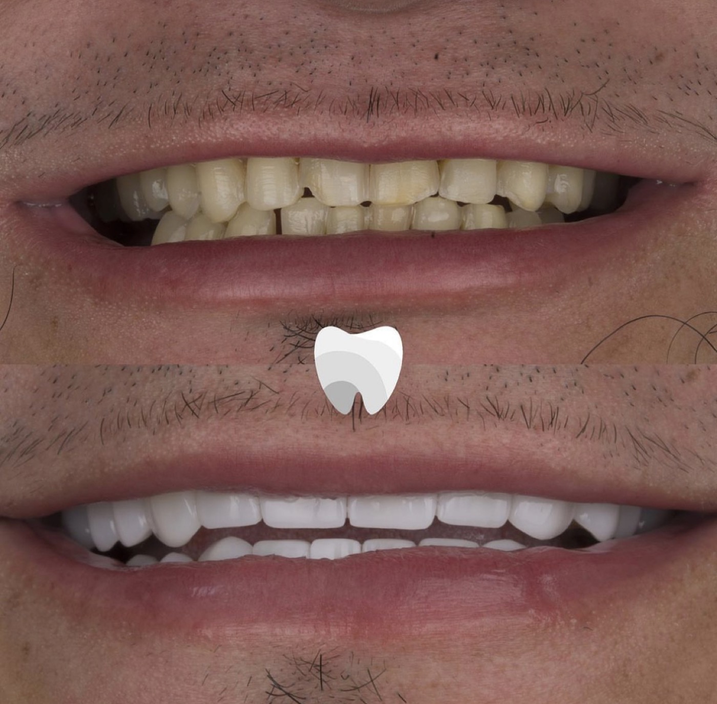 Dental veneers Colombia patient result